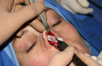 An open approach to surgery - inserting laminated lyophilised donor cartilage along the dorsum of the nose during surgery to correct a saddle depression.