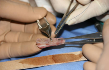 The Nose Clinic uses two strips of lyophilised donor cartilage sutured together to correct saddle depressions of the nose. The lamination stabilises the implant.