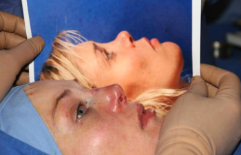 The result of surgery to correct a saddle depression – an attractive nose that complements the shape of the face.