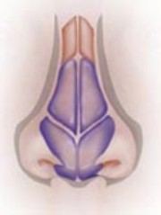 Front View: In this diagram the bony bridge and base of the nose are too broad. The surgeon will sculpt the nose to fit into the triangle.