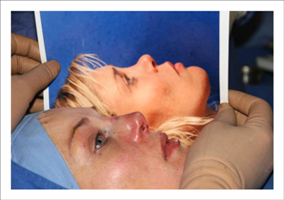 Surgery to correct a saddle depression of the nose: a good result.