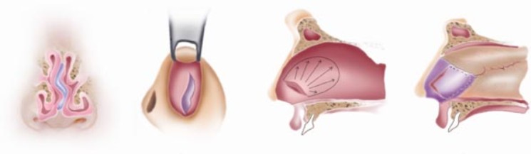 Septoplasty widens the air channels on either side of the nasal septum