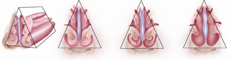 TURBINATE SURGERY ADDRESSES BLOCKAGES OF THE NOSE
