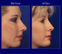 Before & After Nose Surgery 1