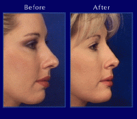 Before & After Nose Surgery 1 Before & After Nose Surgery 1
