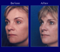 Before & After Nose Surgery 11 Before & After Nose Surgery 11