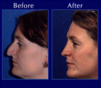 Before & After Nose Surgery 15