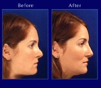 Before & After Nose Surgery 2