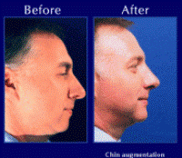 Before & After Nose Surgery 20