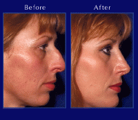 Before & After Nose Surgery 3 Before & After Nose Surgery 3
