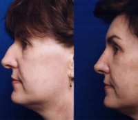Before & After Nose Surgery 38 Before & After Nose Surgery 38