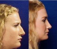 Before & After Nose Surgery 40