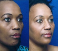 Before & After Nose Surgery 47