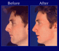 Before & After Nose Surgery 5