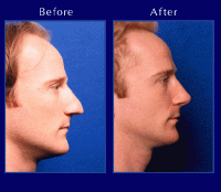 Before & After Nose Surgery 6
