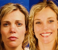 Before & After Nose Surgery 42