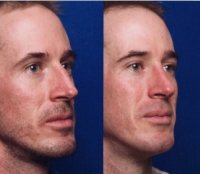 Before & After Nose Surgery 44