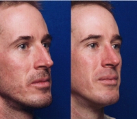 Before & After Nose Surgery 44 Before & After Nose Surgery 44