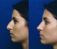 Before & After Nose Surgery 46