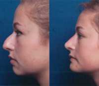 Before & After Nose Surgery 48 Before & After Nose Surgery 48