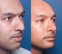 Before & After Nose Surgery 49