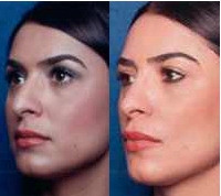 Before & After Nose Surgery 50 Before & After Nose Surgery 50