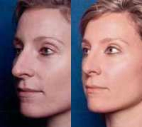 Before & After Nose Surgery 52 Before & After Nose Surgery 52