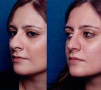 Before & After Nose Surgery 53 Before & After Nose Surgery 53