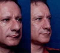 Before & After Nose Surgery 54 Before & After Nose Surgery 54