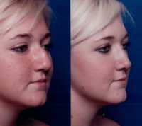 Before & After Nose Surgery 55