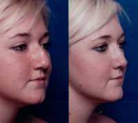 Before & After Nose Surgery 55 Before & After Nose Surgery 55