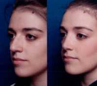 Before & After Nose Surgery 56 Before & After Nose Surgery 56
