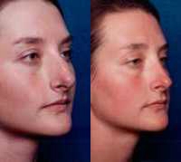 Before & After Nose Surgery 57 Before & After Nose Surgery 57
