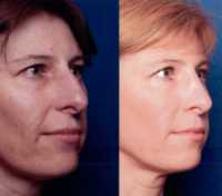 Before & After Nose Surgery 58 Before & After Nose Surgery 58