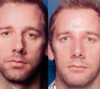 Before & After Nose Surgery 59 Before & After Nose Surgery 59