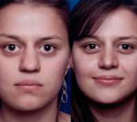 Before & After Nose Surgery 60