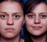 Before & After Nose Surgery 60 Before & After Nose Surgery 60