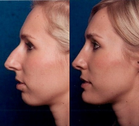 Before & After Nose Surgery 61