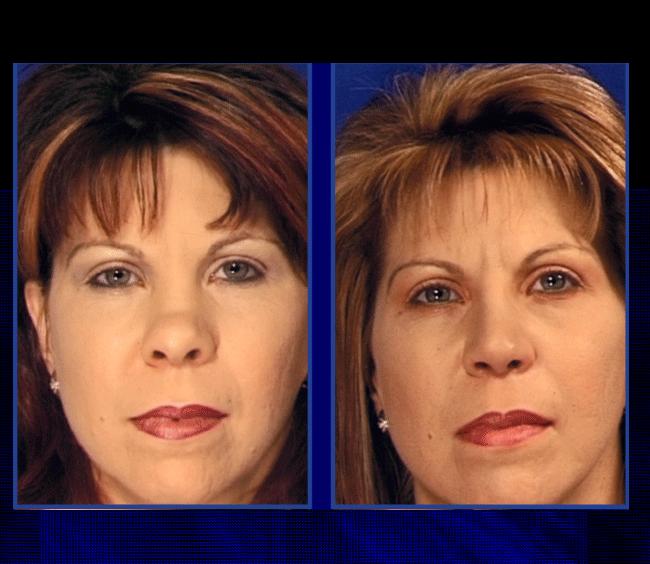 The Nose Clinic Before and After Nose Surgery Photos 19