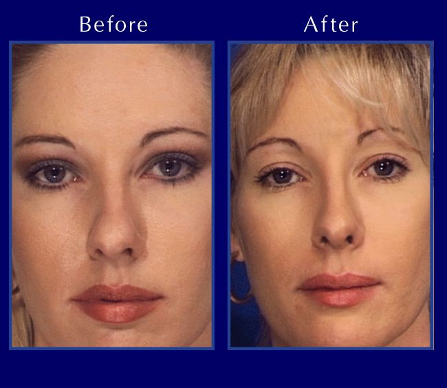 Before and After Nose Surgery Photos 1test